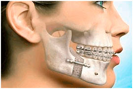 Corrective Jaw Surgery - Temporomandibular joint disorders (TMD)