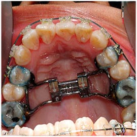 surgical-assisted-rapid-palatal-expansion