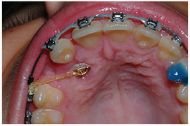 Exposures and Impacted Canines