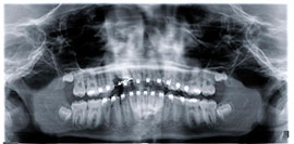 Exposures and Impacted Canines