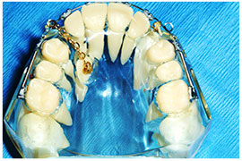 Exposures and Impacted Canines