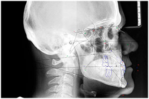 corrective jaw