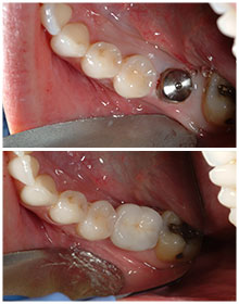 surgical instructions - dental implants