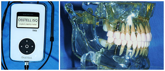 dental implants