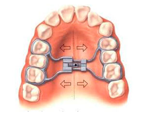 surgical-assisted-rapid-palatal-expansion