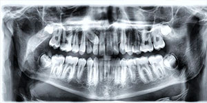 Exposures and Impacted Canines