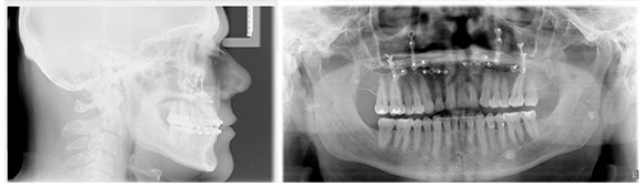 Corrective jaw