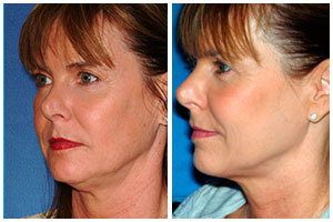 Before and After Photos - Temporomandibular joint disorders (TMD)