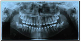 molar-uprighting