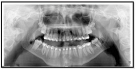 molar-uprighting