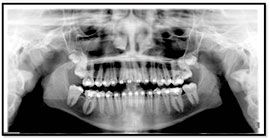 molar-uprighting