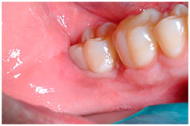 molar-uprighting