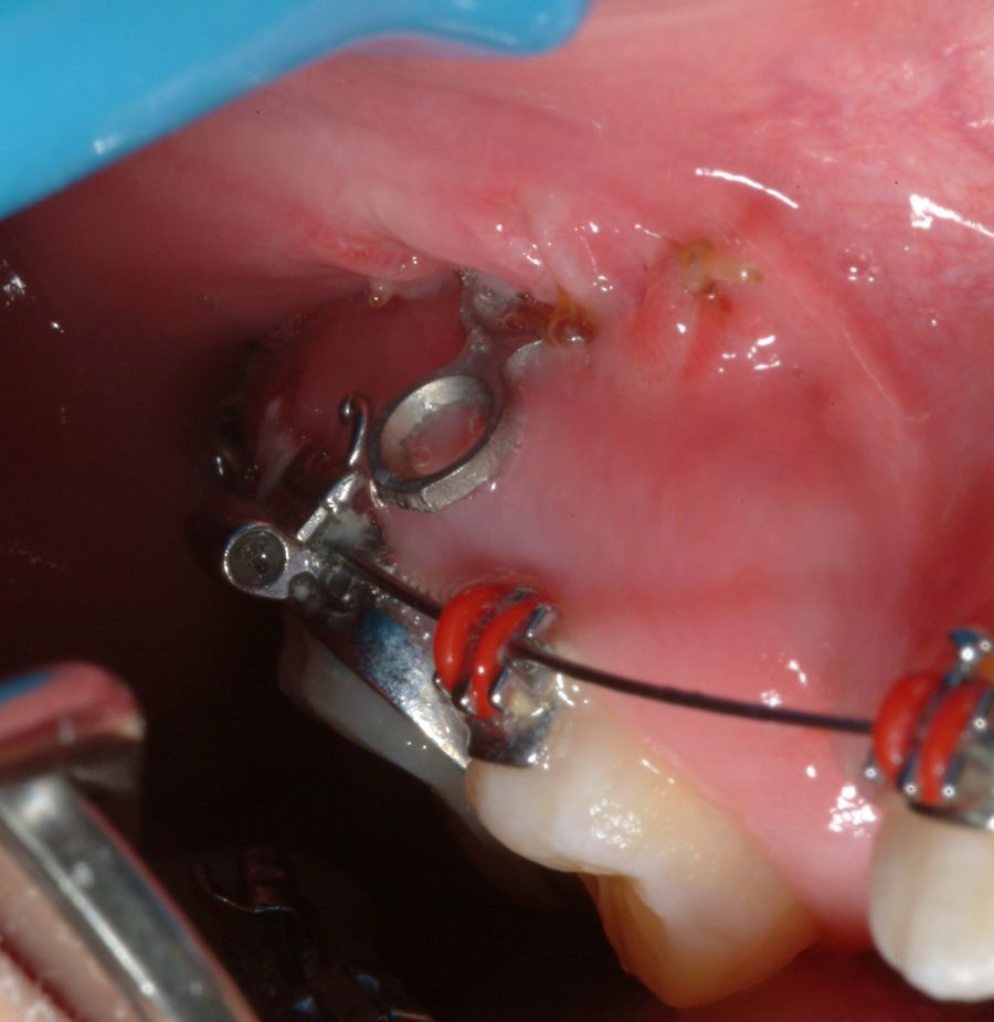 surgical orthodontics