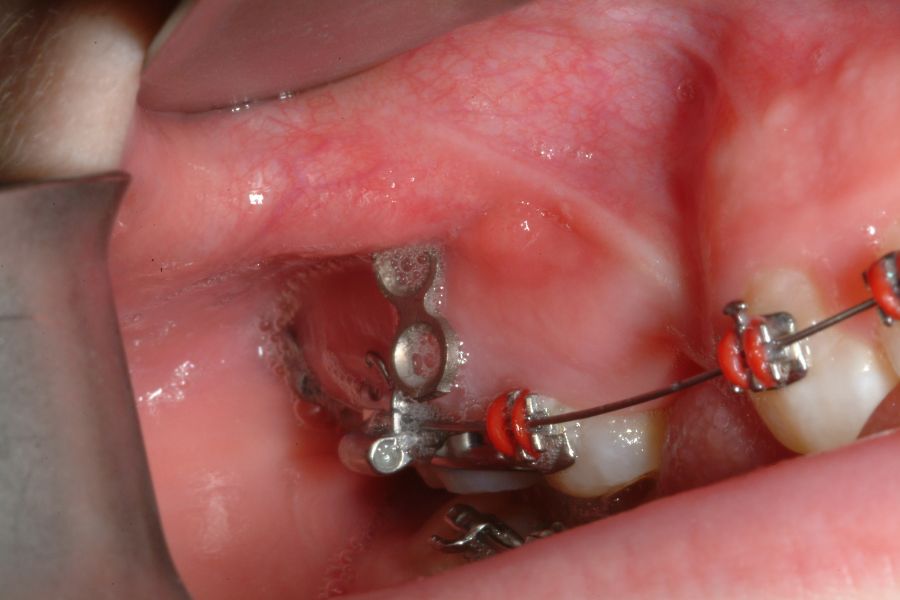 surgical orthodontics