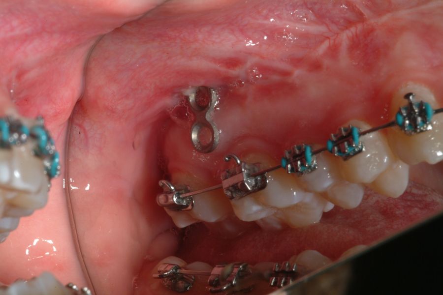 surgical orthodontics