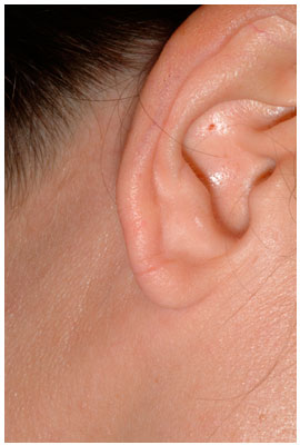 ear lobe repair dr. diaz