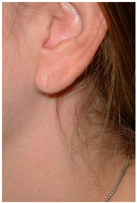 ear lobe repair dr. diaz