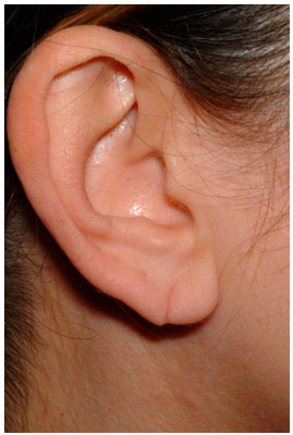 ear lobe repair dr. diaz