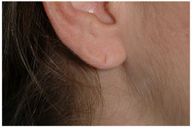 Ear Lobe Repair - Cosmetic procedures are performed