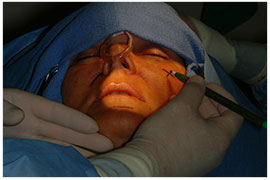 Fat Transfer - Cosmetic procedures are performed