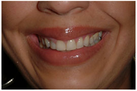 Lip Repositioning - Cosmetic procedures are performed