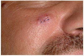 Scar Revision - Cosmetic procedures are performed