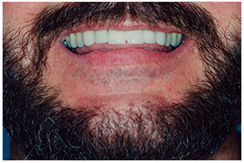 scar revision