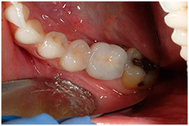 Dental Implants - Temporomandibular joint disorders (TMD)