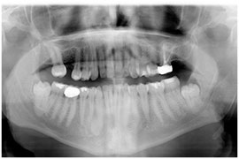 Impactions & Wisdom Teeth - Temporomandibular joint disorders (TMD)