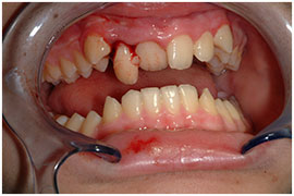 Trauma - Temporomandibular joint disorders (TMD)