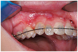 Exposures and Impacted Canines