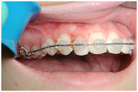 Exposures and Impacted Canines