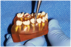 Exposures and Impacted Canines