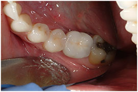 Dental Implants - Surgical instructions Oral Surgeon
