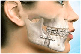 Corrective Jaw Surgery - Surgical instructions Oral Surgeon